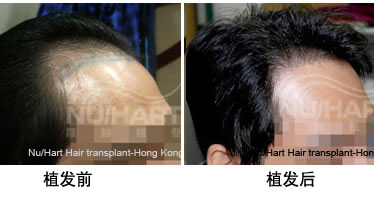 香港显赫植发案例 男性前额光秃实施植发手术