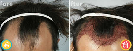 中国台湾dr.liu植发中心植发案例 雄性秃四期植发手术效果