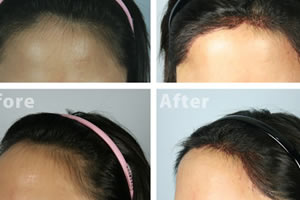中国台湾dr.liu植发中心真实案例 种植发际线摆脱高额头