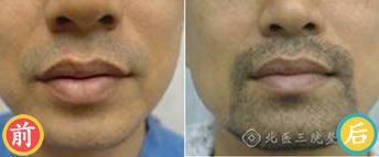 北京三院做的胡须移植