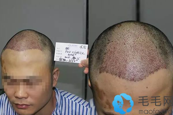 广州雍禾植发手术完成照片