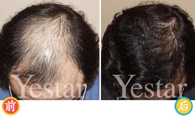 北京艺星植发男性头发加密植发手术效果对比图