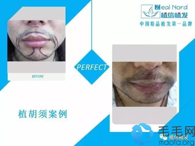 北京植信植发植胡须案例