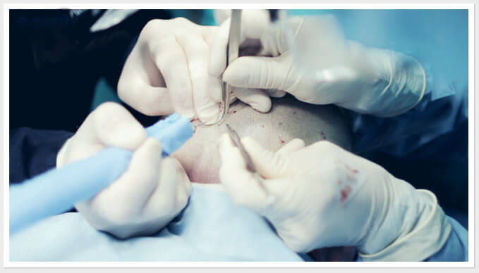 植发手术过程图