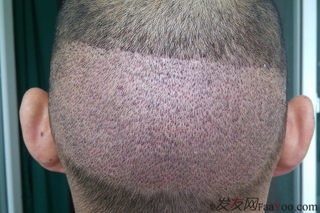 脱发四年，终于在郑州碧莲盛做了植发