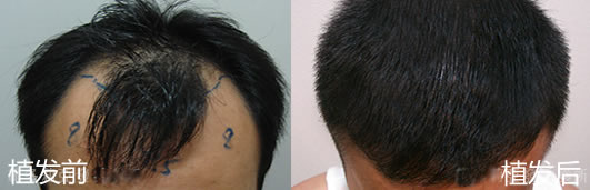 小O型雄性秃第四期初的患者在植发术后10个月照片