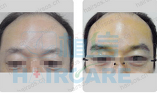北京植信植发中心 眉毛种植案例
