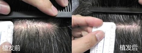 香港美丝植发中心男士疤痕修复案例