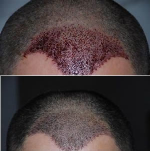 乌鲁木齐植发中心案例 发际线调整术后样子