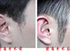 郑州二七医院鬓角毛发移植案例前后对比