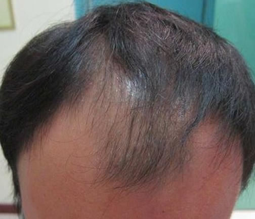 什么原因导致前额脱发