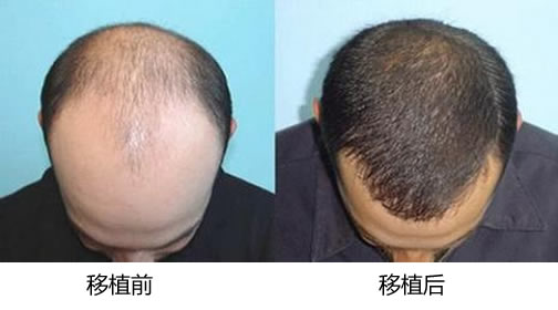 头发移植解决前额头发稀少的案例