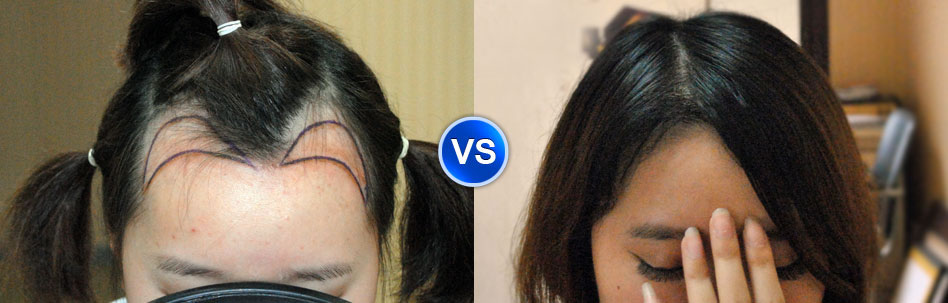 雍禾植发案例：文女士使用技术： FUE-APL1.0无痕植发技术种植单位：1000脱发类型：脂溢性脱发（2级）