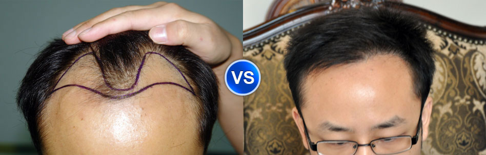 雍禾植发案例：杨先生使用技术： FUE-APL1.0无痕植发技术种植单位：1580脱发类型：脂溢性脱发（2级）