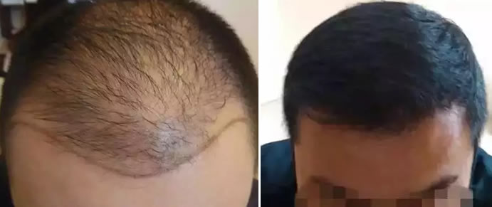 李先生植发前与植发后不到1年的效果对比