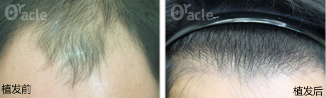 韩国奥拉克植发中心男性发际线调整案例前后效果对比