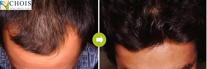 韩国乔颜思chois植发中心男性调整发际线手术前后效果对比