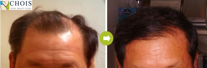 韩国乔颜思chois植发中心为男性实施植发手术效果对比