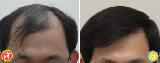 上海美莱毛发移植中心男性秃顶植发案例效果图