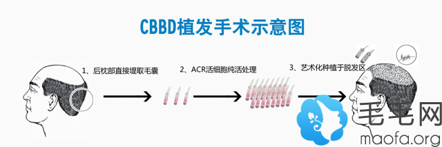 CBBD三维动态双极速植发术植发流程