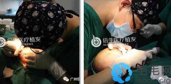 广州倍生植发手术过程之毛囊提取