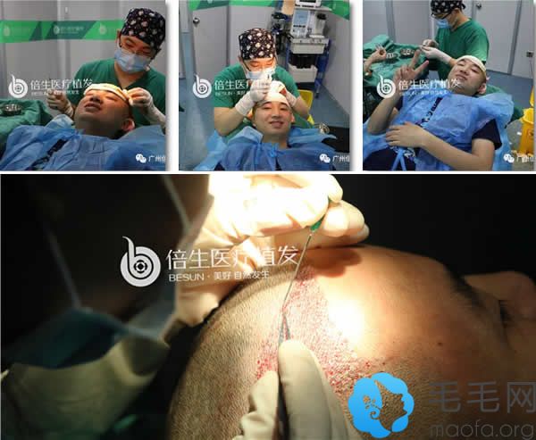广州倍生植发植发手术过程