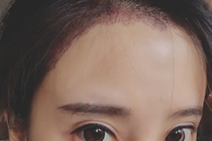 LOL女主播冯提莫微博自曝种植发际线照片 植发化解秃顶之灾