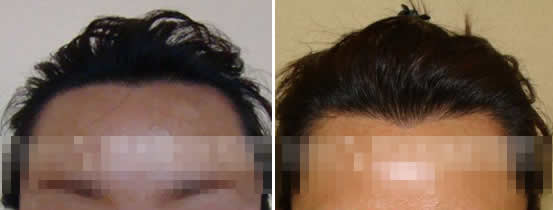 29岁张小姐在重庆时光毛发移植中心种植美人尖过程图
