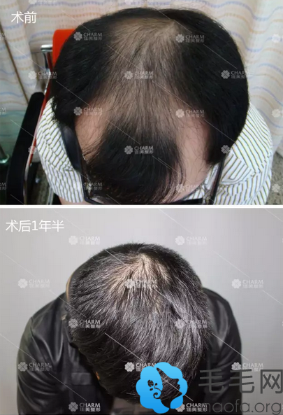 植发前后对比图