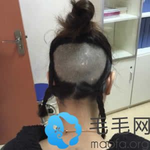 广济医院植发手术取毛囊照片