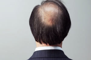 为什么说植发对脱发是比较有效的根治办法？