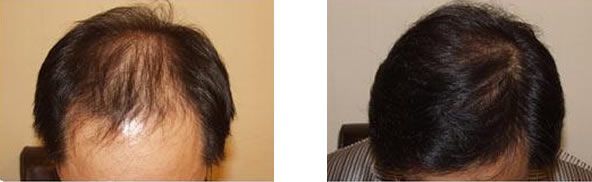 植发治疗脱发前后效果对比图