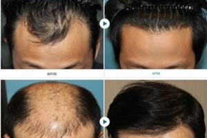 北京科发源植发：植发后有多少毛囊可以存活？