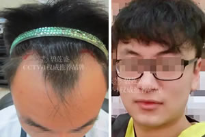 北京碧莲盛小陈的治脱经历 M型脱发植发11个月做回黑发少年