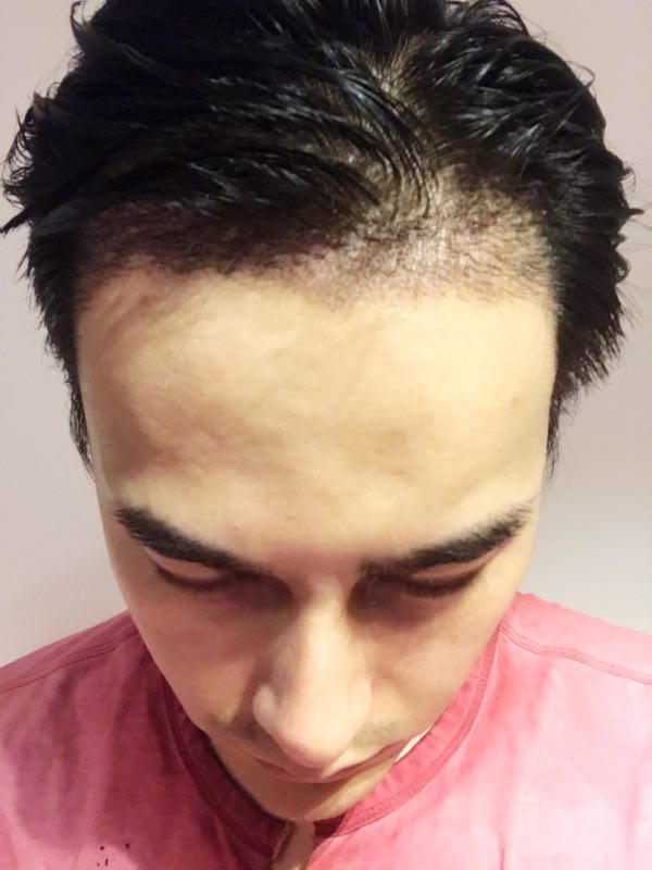 成美植发中心男性种植发际线15天效果