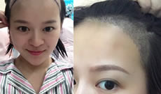 杨女士在西安雍禾种植发际线手术后第7天效果日记分享
