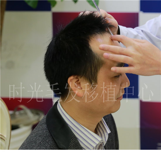 杭州时光植发中心面诊过程
