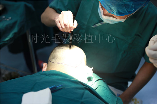 植发手术之毛囊提取过程