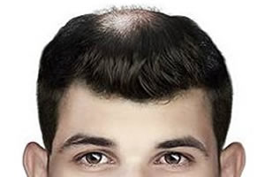 为什么脱发从头顶和发际线开始？植发还是用药物治疗好？