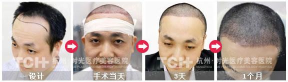 杭州时光种植发际线1个月恢复图
