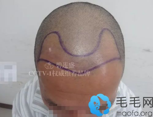 王先生种植发际线手术的方案