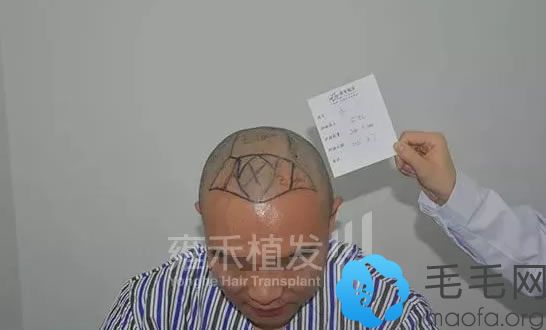 杭州雍禾植发医生设计手术方案