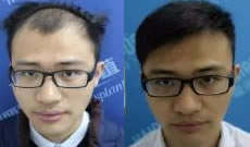 北京植发好不好 95后脱发大学生用植发一年后的效果