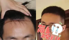 刘先生分享在广州雍禾E+L植发五个月的恢复效果