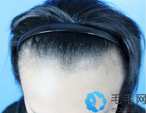 在北京雍禾植发植发际线前的照片