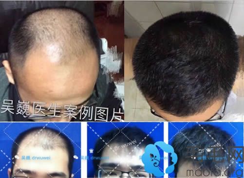上海第九人民医院植发医生吴巍头发种植案例