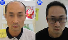 分享三级脱发刘先生在北京科发源植发过程和效果案例