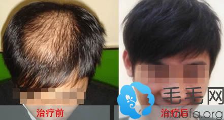 长沙雍禾头顶种植头发术后7个月对比案例