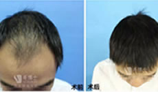 秃顶大叔在北京毛博士植发种植头发的效果超赞