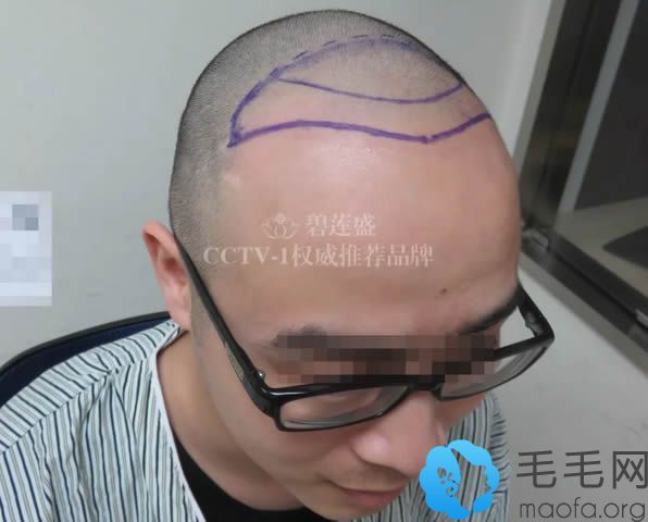 在北京碧莲盛植发进行毛发移植前的照片